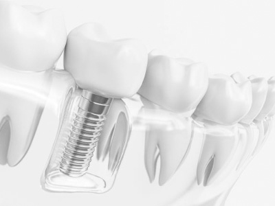 Tratamentos Odontológicos - Cachoeirinha - SP